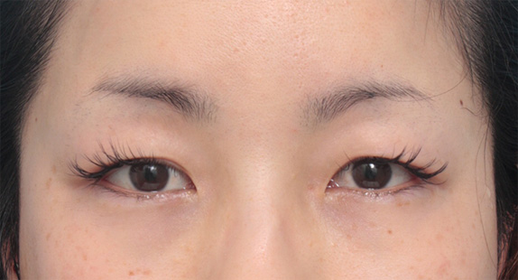 二重まぶた・全切開法,患者様の希望で、かなり幅の広い平行型二重を全切開法で作った症例写真,Before,ba_sekkai33_b.jpg