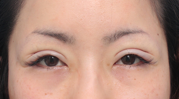 二重まぶた・全切開法,患者様の希望で、かなり幅の広い平行型二重を全切開法で作った症例写真,手術直後,mainpic_sekkai16b.jpg
