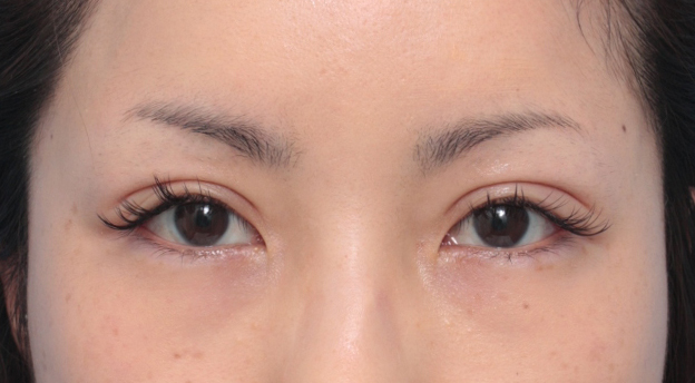 二重まぶた・全切開法,患者様の希望で、かなり幅の広い平行型二重を全切開法で作った症例写真,1ヶ月後,mainpic_sekkai16d.jpg