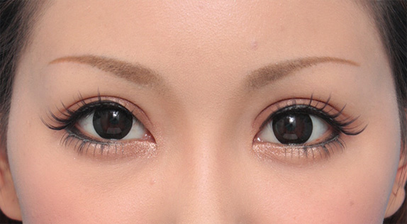 症例写真,患者様の希望で二重まぶた全切開法でかなり幅の広い平行型二重を作った症例写真,After(メイクあり)<br/>
(6ヶ月後),