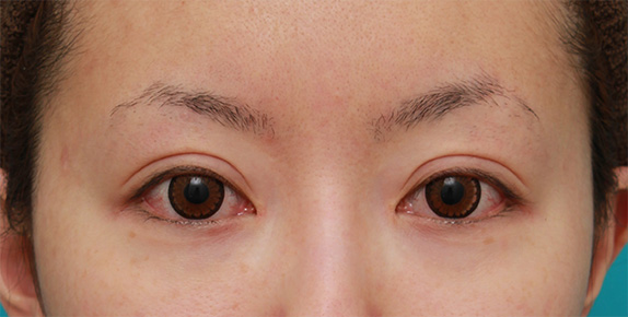 症例写真,他院で行われたくい込みの弱い二重まぶた切開法を、修正手術で幅を広げて、尚且つ、くい込みを強くし、目頭切開も行った症例写真,After(カラコンあり),