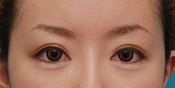 症例写真,他院で行われたくい込みの弱い二重まぶた切開法を、修正手術で幅を広げて、尚且つ、くい込みを強くし、目頭切開も行った症例写真,After(カラコン、メイクあり)<br/>
(6ヶ月後),