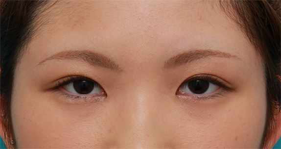 症例写真,二重まぶた全切開法で脂肪をとり、幅の狭い末広型二重を作った症例写真,After(メイクあり)<br/>
(6ヶ月後),