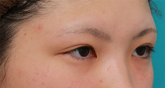 症例写真,二重まぶた全切開法で脂肪をとり、幅の狭い末広型二重を作った症例写真,After(6ヶ月後),ba_sekkai38_b.jpg