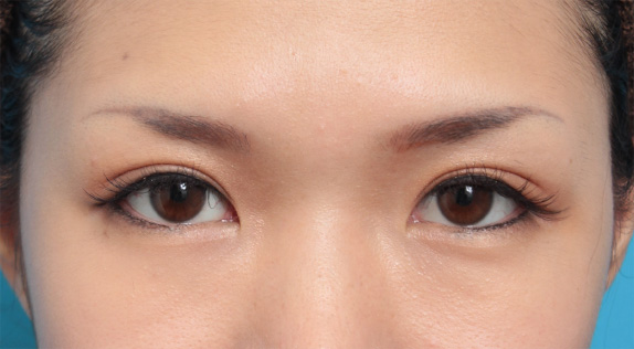 症例写真,二重まぶた全切開法で平行型と末広型の中間にした症例写真,After(メイクあり)<br/>
(6ヶ月後),