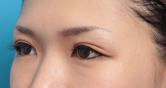 症例写真,二重まぶた全切開法で平行型と末広型の中間にした症例写真,After(メイクあり)<br/>
(6ヶ月後),