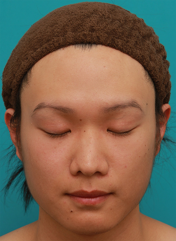 症例写真,全切開法で幅の広い平行型二重まぶたを作った男性の症例写真,After(目を閉じた状態)<br/>
(6ヶ月後),