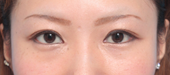 症例写真,目頭切開の症例 蒙古襞が発達して目と目が離れていた20代女性,After(メイクあり)<br/>
(1ヶ月後),