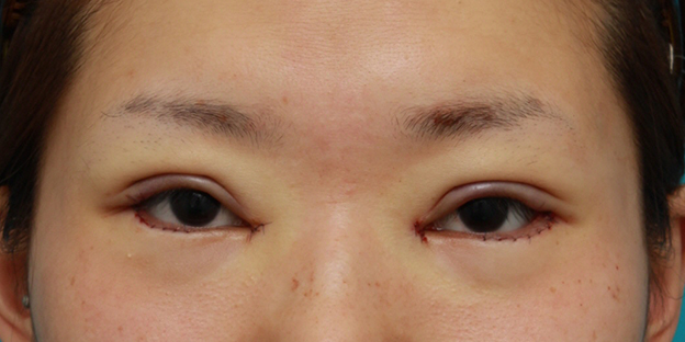 目尻切開,目頭切開+目尻切開+タレ目形成+眼瞼下垂手術で目を一周り大きくした症例写真,手術直後,mainpic_megashira06b.jpg