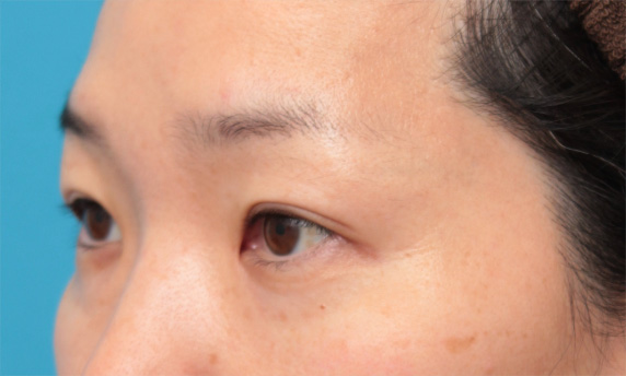 症例写真,目頭切開+二重まぶたミニ切開法で末広型二重を作った症例写真,After(6ヶ月後),ba_megashira28_b.jpg