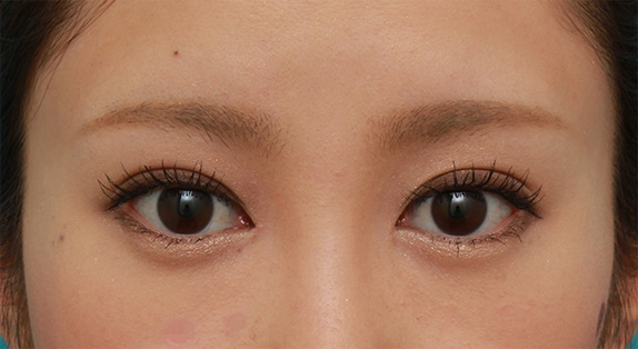 目尻切開,目頭切開+目尻切開で目の横幅を内側と外側に広げた20代女性の症例写真,After(メイクあり)<br/>
(4ヶ月後),