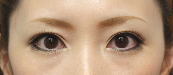 症例写真,眼瞼下垂(がんけんかすい) まぶたが重そうな20代女性の症例,After(メイクあり),