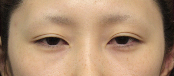 症例写真,眼瞼下垂(がんけんかすい) まぶたが重そうな20代女性の症例,Before,ba_ganken26_b.jpg