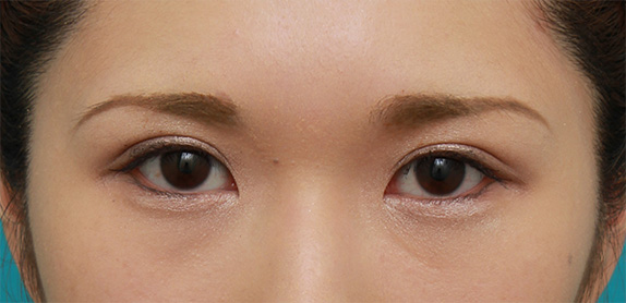 二重まぶた・全切開法,二重まぶた全切開法で平行型と末広型の中間くらいの二重を作った症例写真の術前術後画像,After(メイクあり)<br/>
(4ヶ月後),