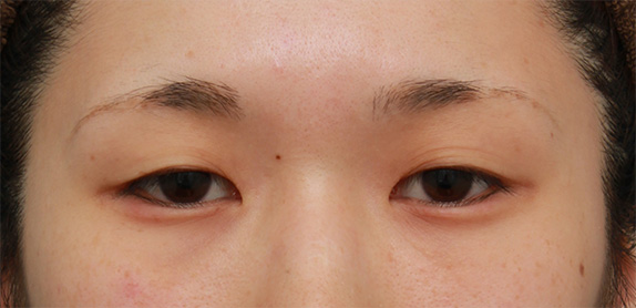 二重まぶた・全切開法,二重まぶた全切開法で平行型と末広型の中間くらいの二重を作った症例写真の術前術後画像,Before,ba_sekkai48_b.jpg
