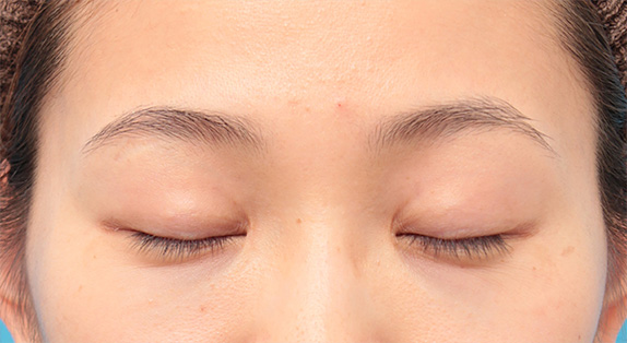 症例写真,二重まぶた埋没法をした後、ほぼ同じ幅、同じラインで全切開法をした症例写真の術前術後画像,After(目を閉じた状態)<br/>
(6ヶ月後),