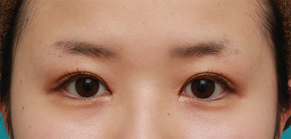 症例写真,目頭切開+二重まぶた全切開法で、大きく印象を変えずに目をぱっちりさせた症例写真の術前術後画像,After(メイクあり)<br/>
(2ヶ月後),