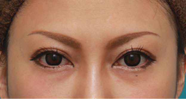 目の下の脂肪取り,二重まぶた全切開法+目尻切開+タレ目形成(グラマラスライン)+目の下脂肪取りで目の印象を変えた症例写真の術前術後画像,6ヶ月後,メイクあり,mainpic_sekkai31j.jpg