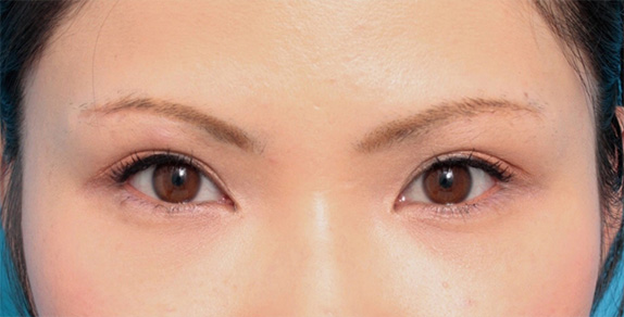 症例写真,眉下リフト(上眼瞼リフト)で二重の幅を広げた20代女性の症例写真,After(メイクあり)<br/>
(6ヶ月後),