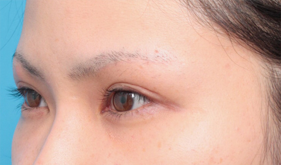 症例写真,眉下リフト(上眼瞼リフト)で二重の幅を広げた20代女性の症例写真,After(メイクなし),ba_jougankenlift02_b.jpg