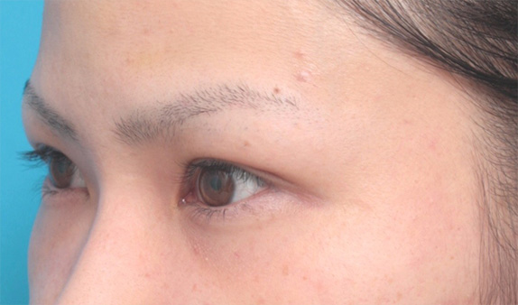 症例写真,眉下リフト(上眼瞼リフト)で二重の幅を広げた20代女性の症例写真,Before,ba_jougankenlift02_b.jpg