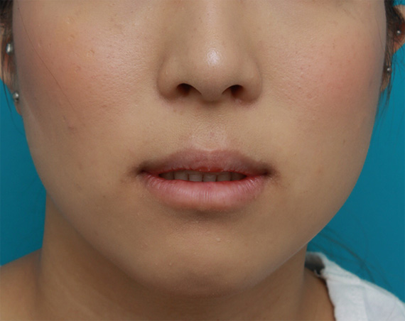 症例写真,下唇のみを手術で薄くして、バランスを整えた症例写真,After(3ヶ月後),