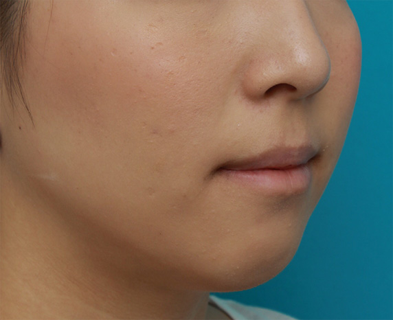 症例写真,下唇のみを手術で薄くして、バランスを整えた症例写真,After(3ヶ月後),ba_usuku15_b.jpg