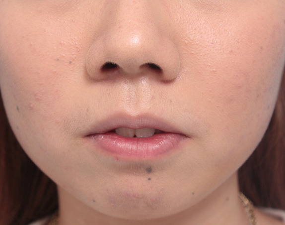 唇を薄く(口唇縮小術),タラコ唇の人に、手術で上下の唇を薄くした症例写真,After(10日後),ba_usuku13_b.jpg