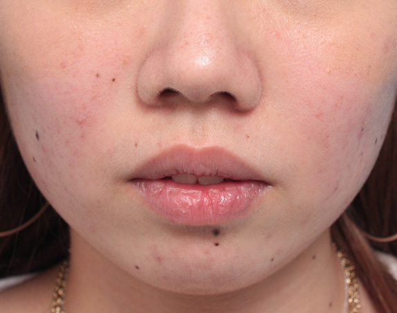 唇を薄く(口唇縮小術),タラコ唇の人に、手術で上下の唇を薄くした症例写真,Before,ba_usuku13_b.jpg