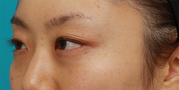 目の下の脂肪取り,目の下の脂肪取り症例写真,After(1ヶ月後),ba_shibo09_b.jpg