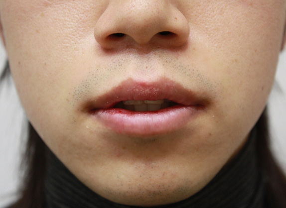 唇を薄く(口唇縮小術),くちびる薄くする手術の症例写真,After(10日後),ba_usuku11_b.jpg