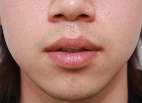 唇を薄く(口唇縮小術),くちびる薄くする手術の症例写真,Before,ba_usuku11_b.jpg