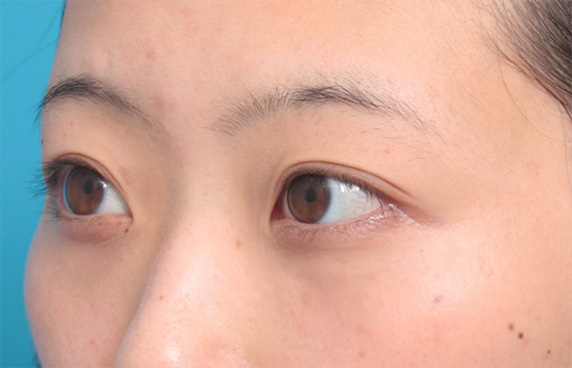 目の下の脂肪取り,目の下の脂肪を除去して、クマを目立たなくした症例写真,After(1ヶ月後),ba_shibo11_b.jpg
