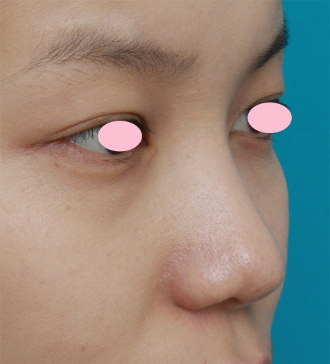症例写真,鼻先と鼻柱基部に耳介軟骨移植をし、鼻翼(小鼻)縮小した症例写真,After(2ヶ月後),ba_jikai27_b.jpg