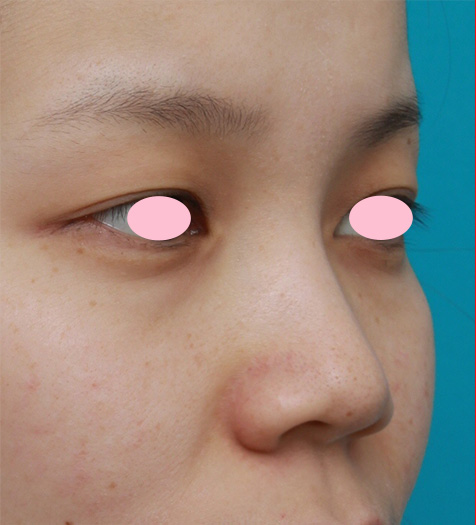 症例写真,鼻先と鼻柱基部に耳介軟骨移植をし、鼻翼(小鼻)縮小した症例写真,Before,ba_jikai27_b.jpg