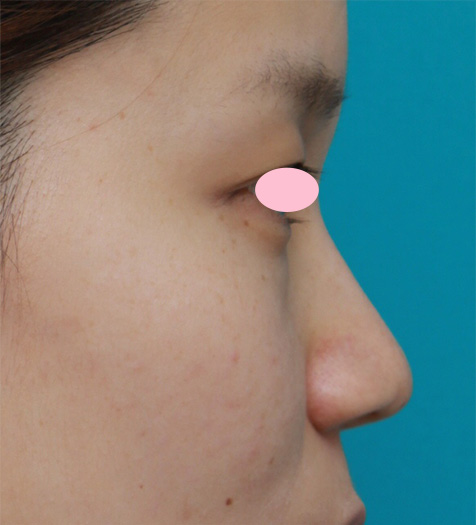 症例写真,鼻先と鼻柱基部に耳介軟骨移植をし、鼻翼(小鼻)縮小した症例写真,After(2ヶ月後),ba_jikai28_b.jpg