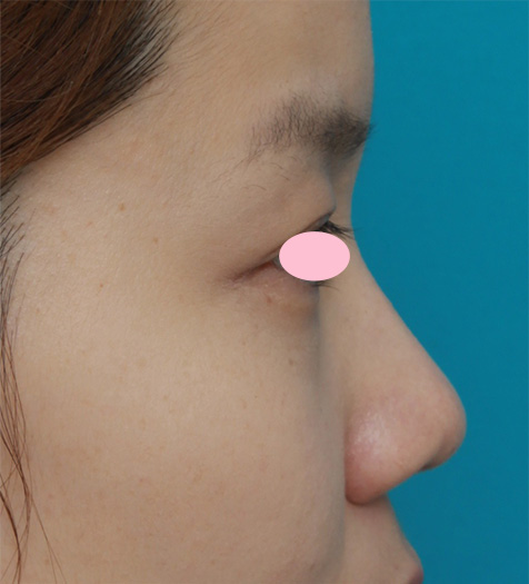 症例写真,鼻先と鼻柱基部に耳介軟骨移植をし、鼻翼(小鼻)縮小した症例写真,Before,ba_jikai28_b.jpg