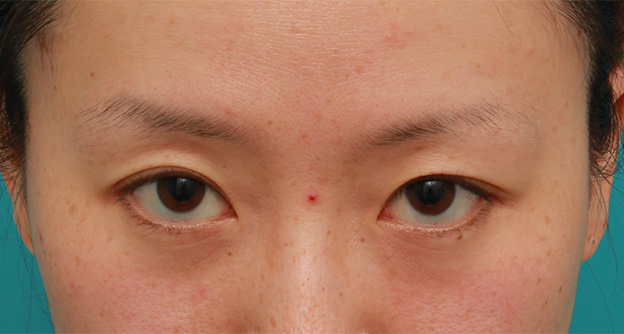 目の下の脂肪取り,片目のみ目の下の脂肪取りをして左右対称に近づけた症例写真の術前術後画像,After(4ヶ月後),ba_shibo14_b.jpg