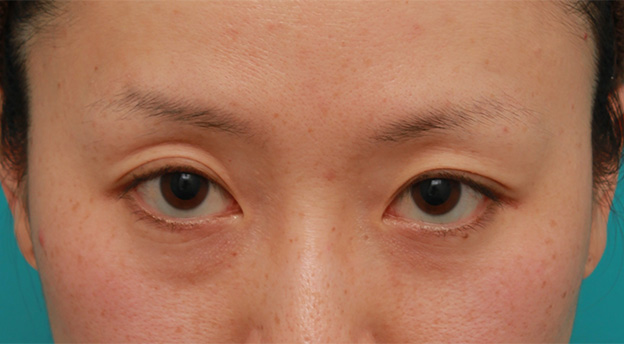 目の下の脂肪取り,片目のみ目の下の脂肪取りをして左右対称に近づけた症例写真の術前術後画像,Before,ba_shibo14_b.jpg