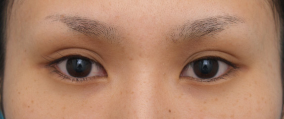 症例写真,なみだ袋形成(ヒアルロン酸注射)の症例 ヒアルロン酸注入,Before,ba_namida05_b.jpg