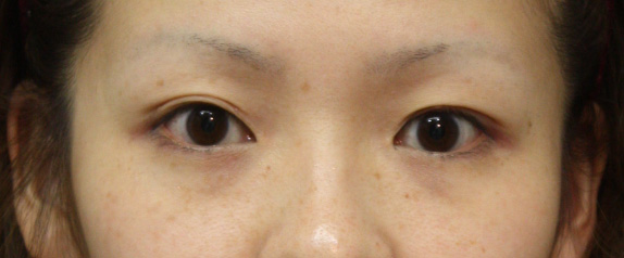 症例写真,なみだ袋形成(ヒアルロン酸注射)の症例 淋しい顔立ちを解消したい女性,Before,ba_namida04_b.jpg