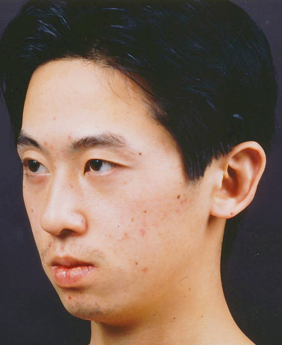 症例写真,あご形成(シリコンプロテーゼ)の症例写真 二重まぶた・全切開法も施行,Before,ba_ago11_b.jpg