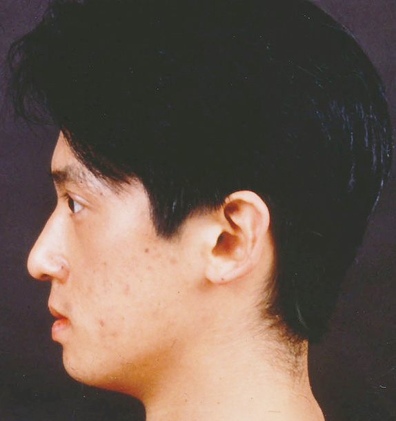 症例写真,あご形成(シリコンプロテーゼ)の症例写真 二重まぶた・全切開法も施行,After,ba_ago12_b.jpg