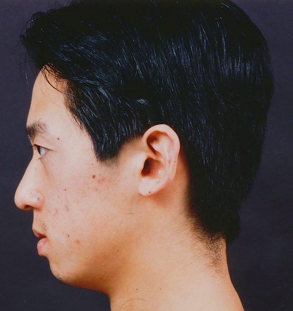 症例写真,あご形成(シリコンプロテーゼ)の症例写真 二重まぶた・全切開法も施行,Before,ba_ago12_b.jpg