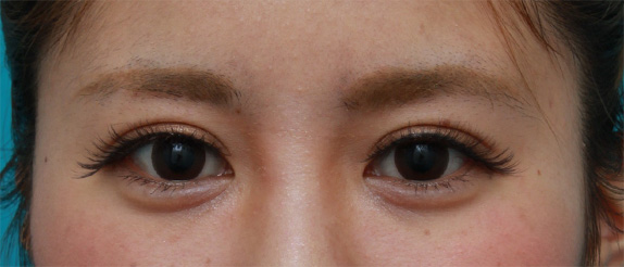 症例写真,ミニ切開法で二重を作った後、ヒアルロン酸で大きめな涙袋を作った症例写真,After(メイクあり)<br/>
(1週間後),