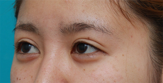 症例写真,ミニ切開法で二重を作った後、ヒアルロン酸で大きめな涙袋を作った症例写真,After(メイクなし),ba_namida12_b.jpg