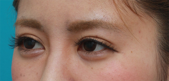 症例写真,ミニ切開法で二重を作った後、ヒアルロン酸で大きめな涙袋を作った症例写真,After(メイクあり)<br/>
(1週間後),