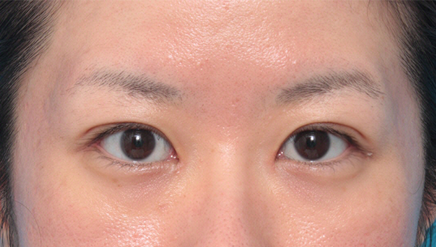 症例写真,目尻切開+たれ目形成術(グラマラスライン)で目を外側と下方に大きくした症例写真,手術前,mainpic_panda06a.jpg