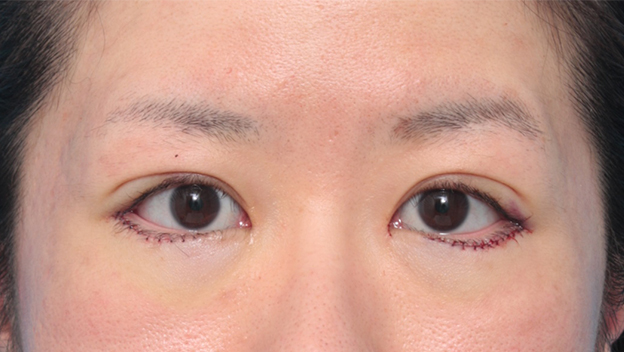 症例写真,目尻切開+たれ目形成術(グラマラスライン)で目を外側と下方に大きくした症例写真,手術直後,mainpic_panda06b.jpg
