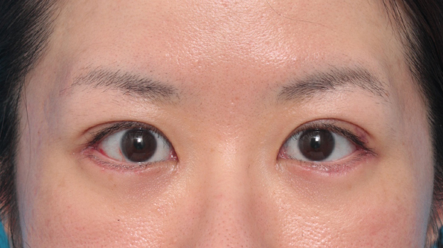 症例写真,目尻切開+たれ目形成術(グラマラスライン)で目を外側と下方に大きくした症例写真,1週間後,mainpic_panda06c.jpg